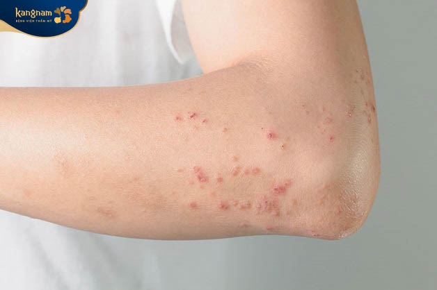 Các nốt mụn ngứa ở tây mọc đơn lẻ hoặc theo tùng cụm