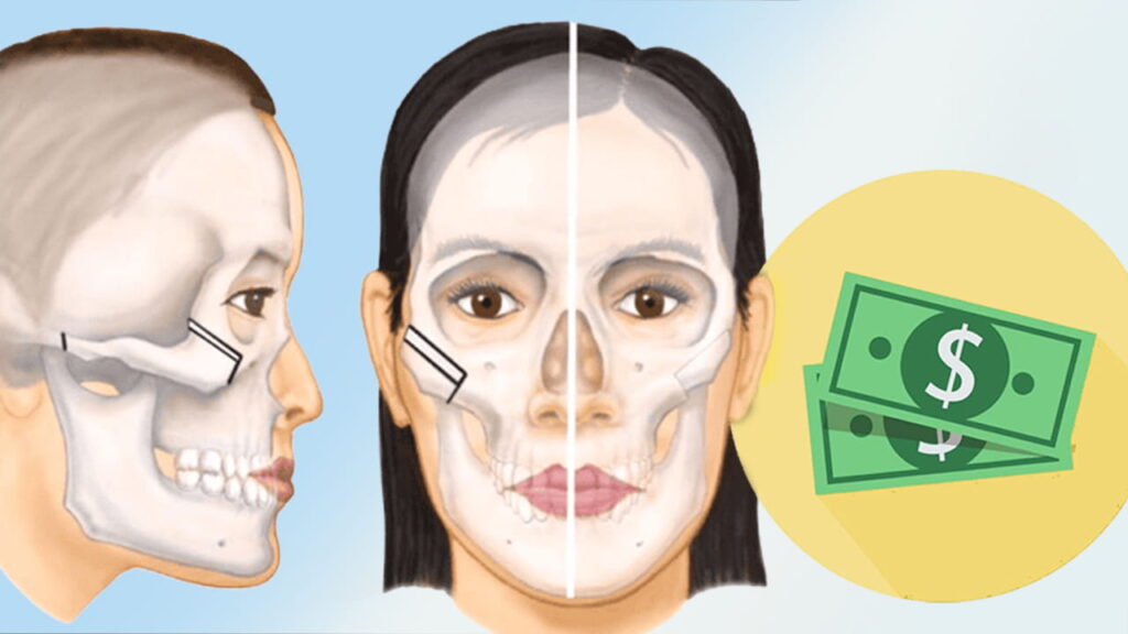 Phẫu thuật hạ xương gò má giá bao nhiêu? Chi tiết chi phí từ A đến Z