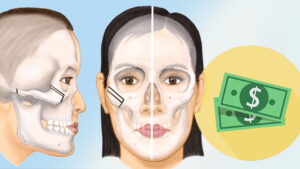 Phẫu thuật hạ xương gò má giá bao nhiêu? Chi tiết chi phí từ A đến Z