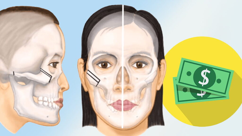 Phẫu thuật hạ xương gò má giá bao nhiêu? Chi tiết chi phí từ A đến Z