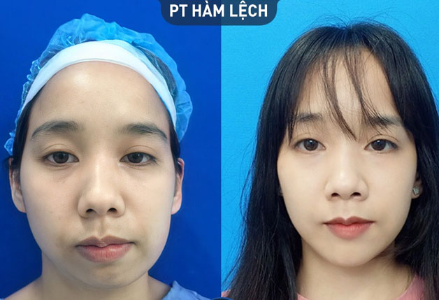 Khắc phục hàm lệch giúp gương mặt cân đối hơn