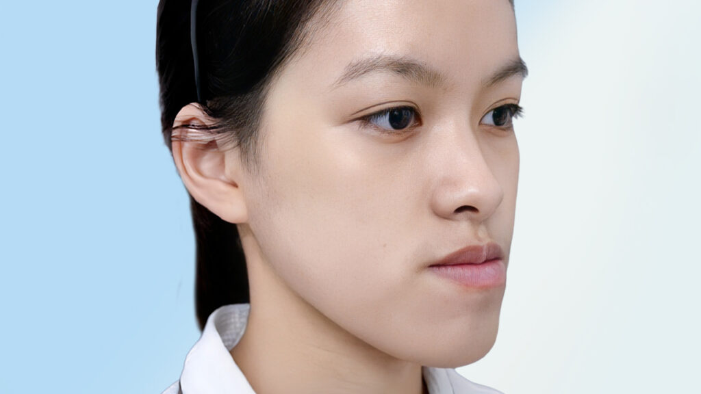 Phẫu thuật hàm móm có nguy hiểm không? Lưu ý trước và sau