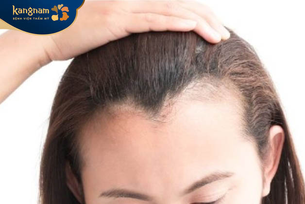 Phụ nữ trán hình chữ M gặp khá nhiều chông gai