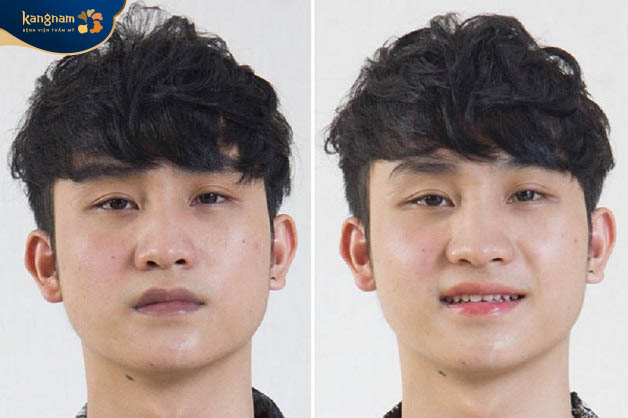Anh Cường khử môi thâm và phun môi tại Kangnam