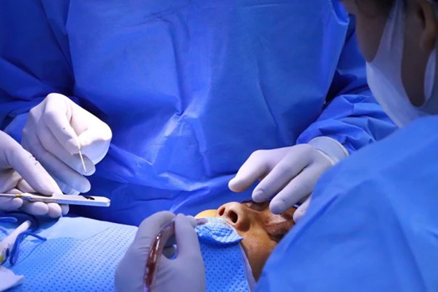 Quá trình tháo sụn mũi