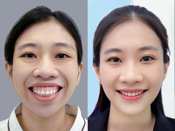 Đường mổ bên trong miệng khi chỉnh hàm nên không để lại sẹo