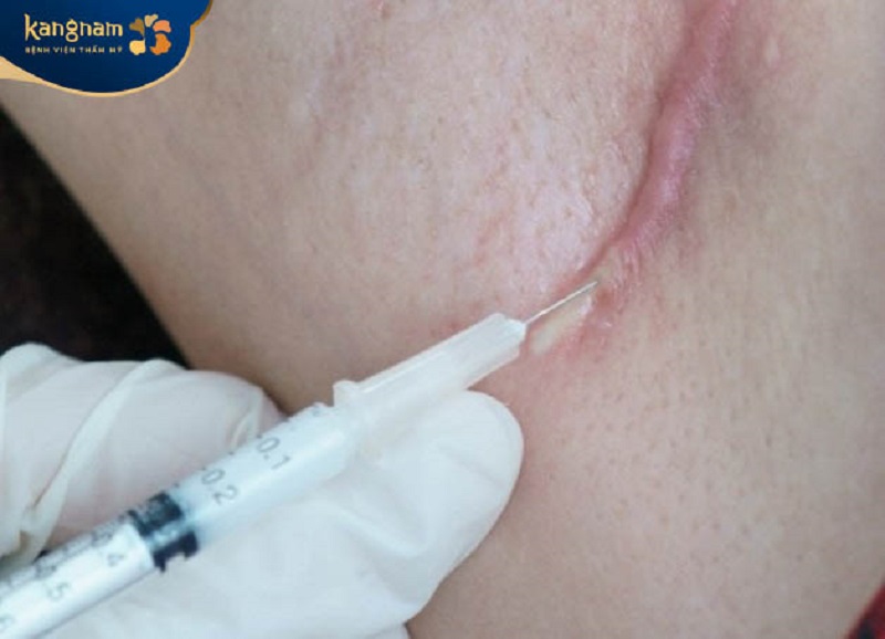 Tiêm Corticosteroid có thể làm mềm vết sẹo lồi