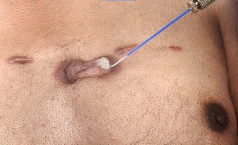 Áp lạnh giúp đóng băng vết sẹo lồi