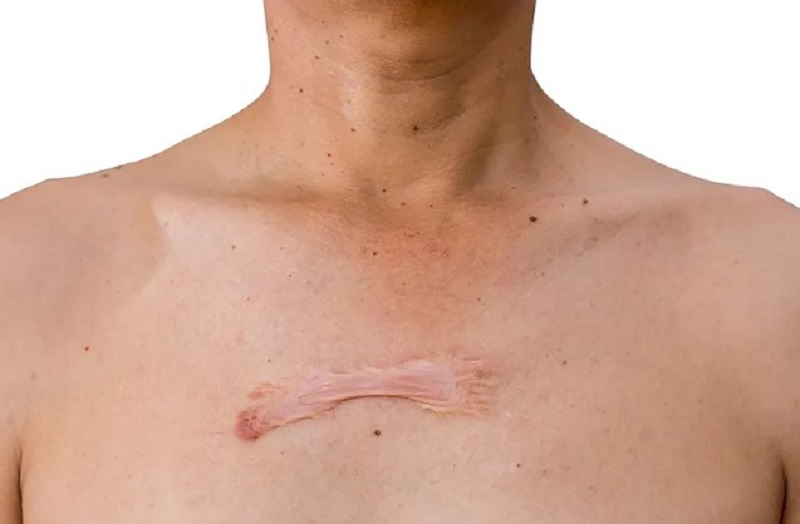 Sẹo lồi cần chăm sóc và điều trị đúng cách để phòng tránh tái phát