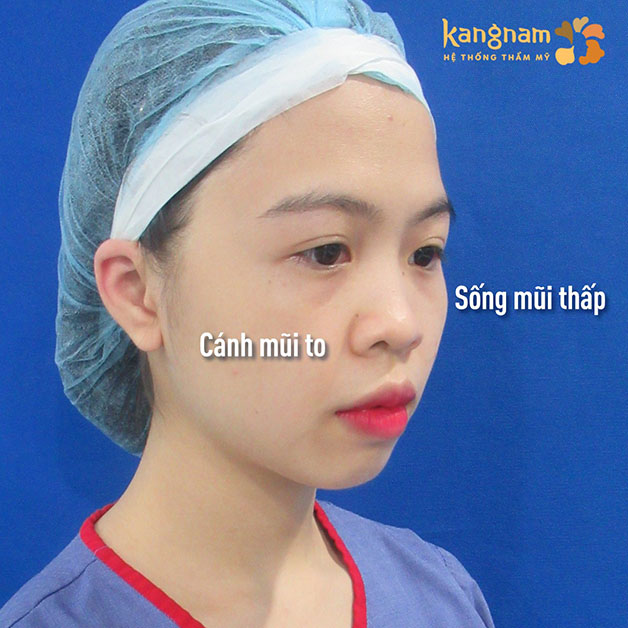 Người có khuyết điểm về mũi như thấp tẹt, mũi hếch