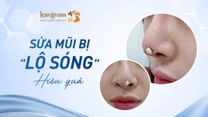 Sửa mũi bị lộ sóng là gì? Nguyên nhân, dấu hiệu và cách khắc phục