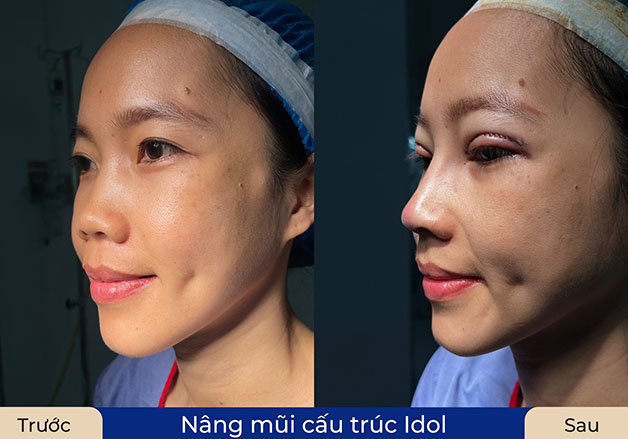 Sử dụng sụn chất lượng, tạo dáng mũi