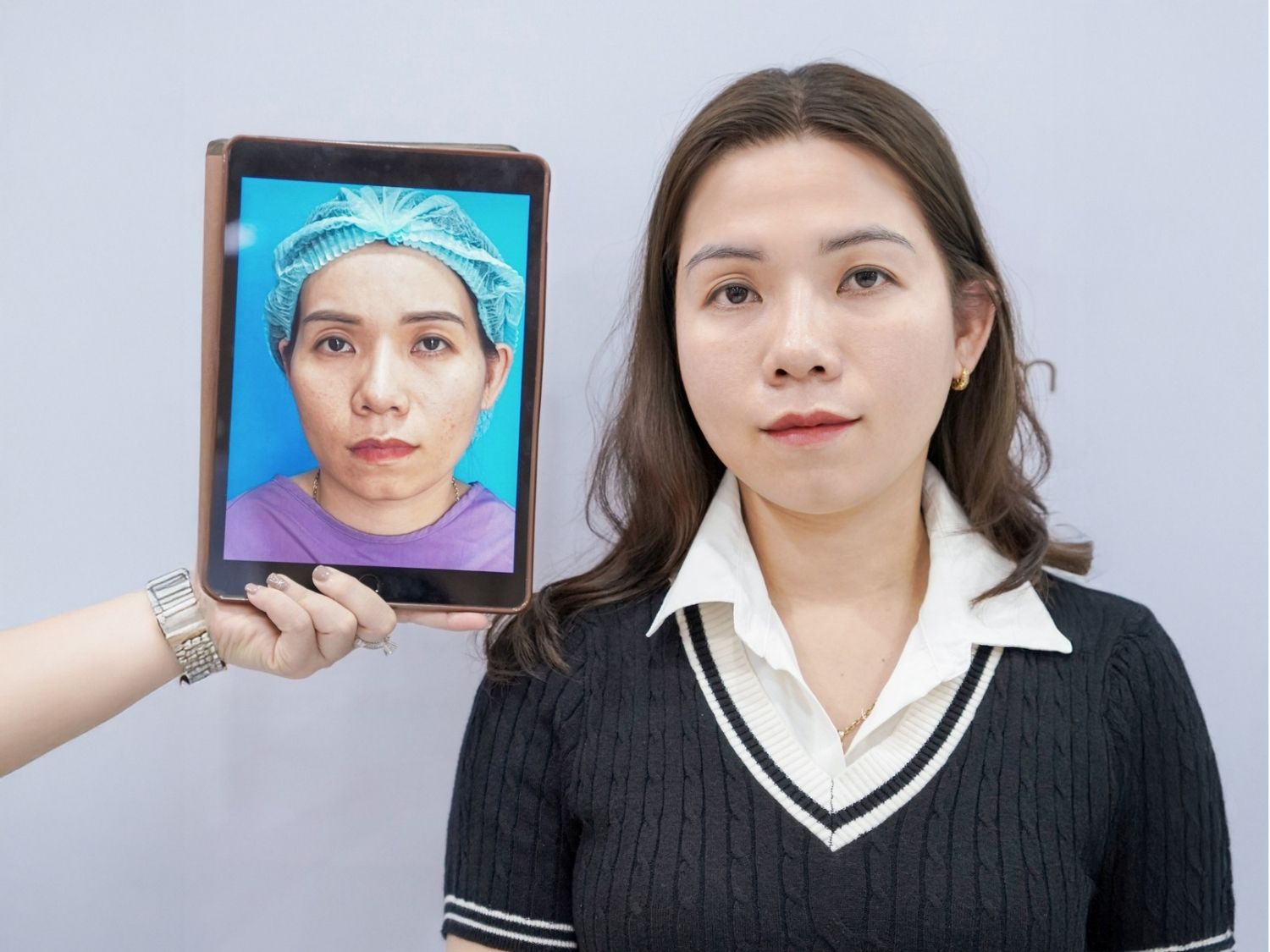 Quá trình hồi phục sau cấy mỡ mặt