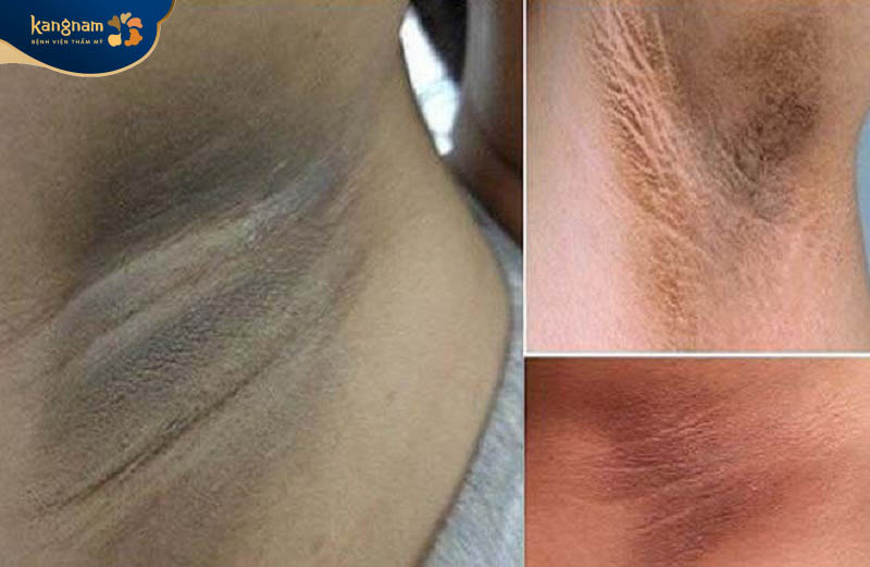 Lượng sắc tốc melanin tăng nhiều gây thâm sạm vùng nách