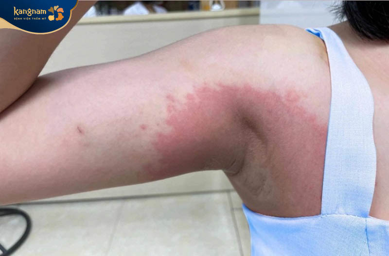 Việc sử dụng sản phẩm không rõ nguồn gốc, gây kích ứng da nách