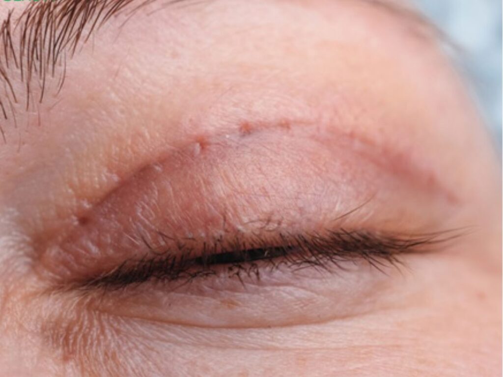 Tốc độ lành phụ thuộc vào cách chăm sóc