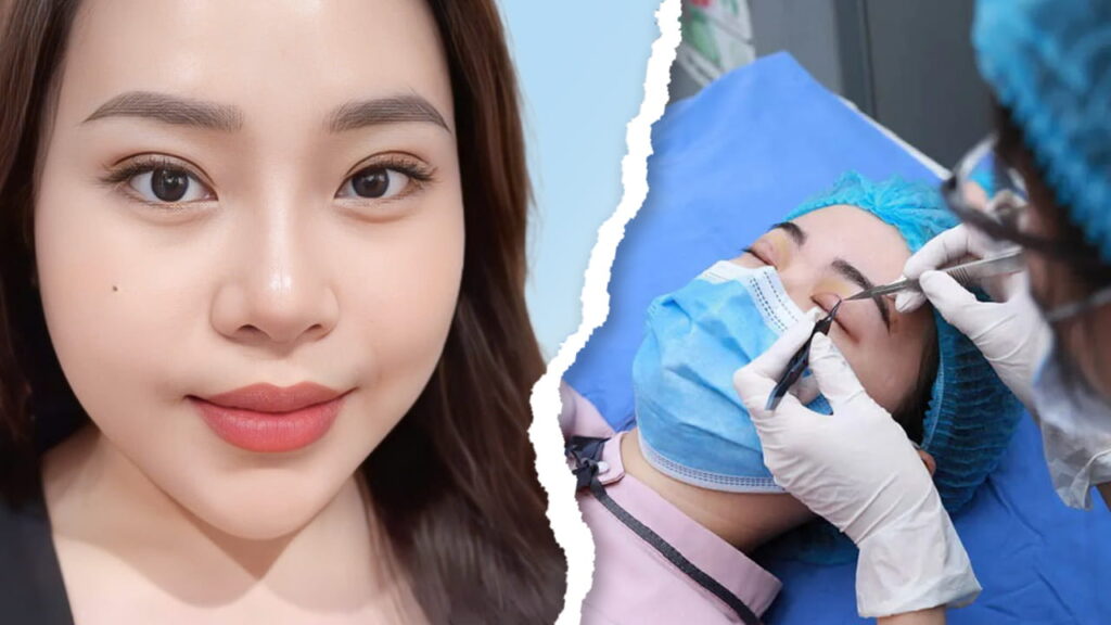 Tháo chỉ nhấn mí có được không? Khi nào cần tháo & thời gian hồi phục