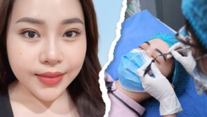 Hướng dẫn tháo chỉ nhấn mí an toàn: Quy trình, thời gian lành và chi phí