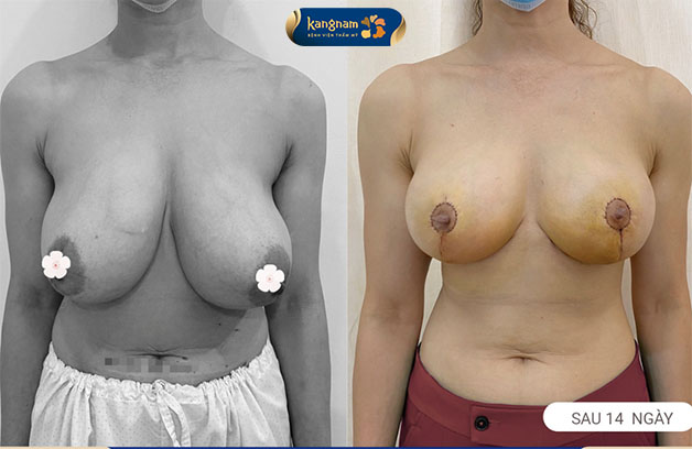 Nâng ngực chảy xệ sau sinh cải thiện vòng 1