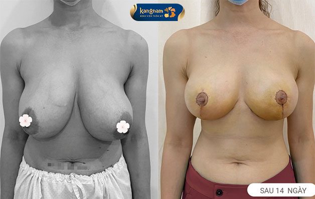 Khách hàng trước và sau khi thu gọn ngực