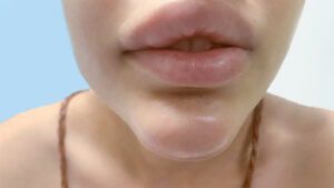 Tiêm filler cằm bị sưng: Nguyên nhân, biểu hiện và cách giảm sưng hiệu quả