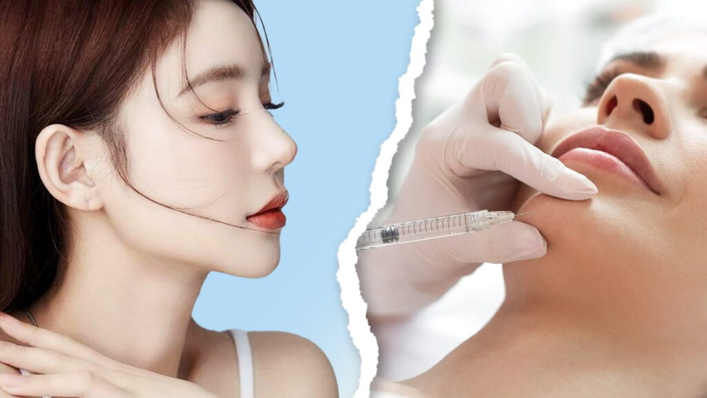 Tiêm Filler Cằm bao lâu thì Đẹp, hết sưng và ổn định? Giải đáp mọi thắc mắc!