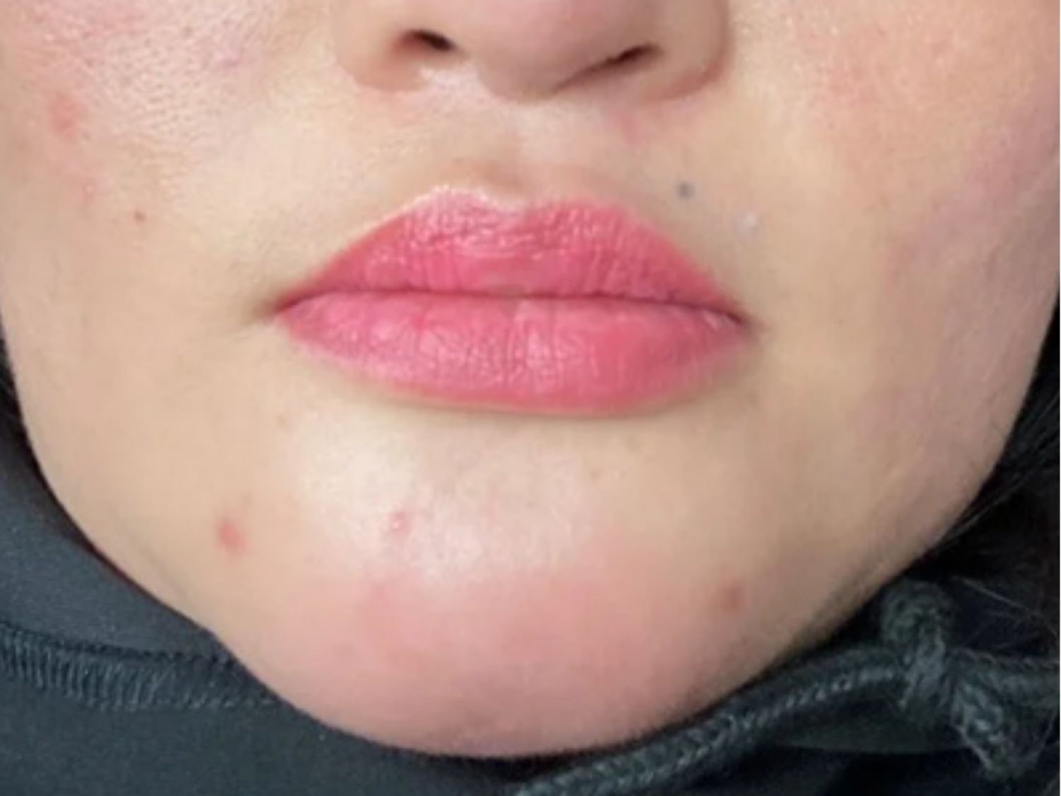 filler "dởm" khiến cằm bị sưng cứng