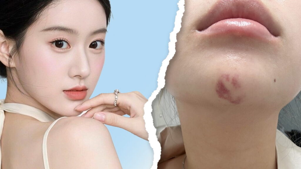 Tiêm filler cằm bị bầm tím: Mức độ bình thường và cách xử lý hiệu quả