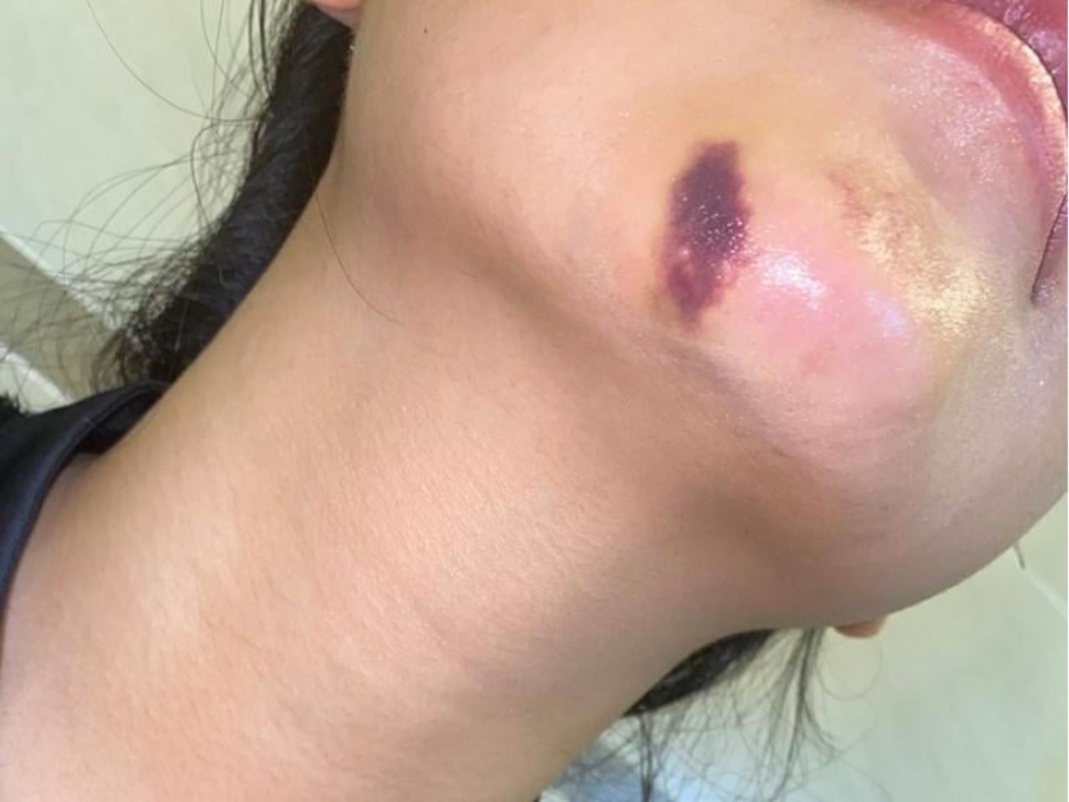 Chất lượng filler không đảm bảo