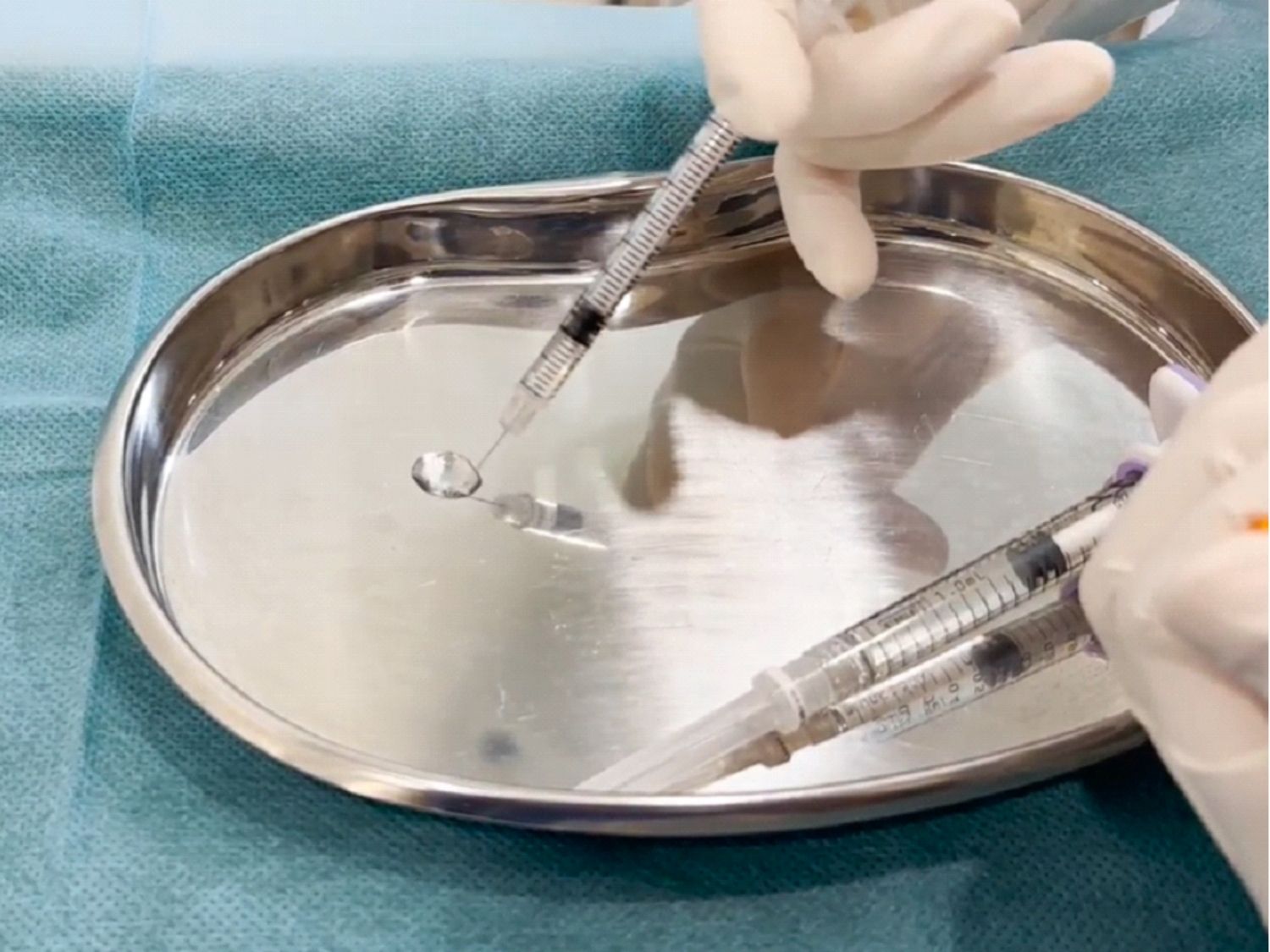 Chất lượng filler tiêm cằm không đảm bảo