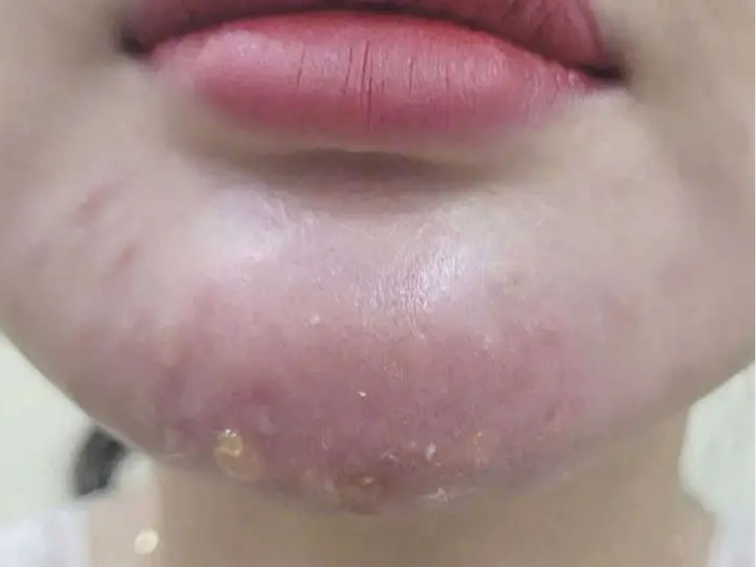 Sưng kéo dài hơn 1 tuần và ngày càng tăng lên