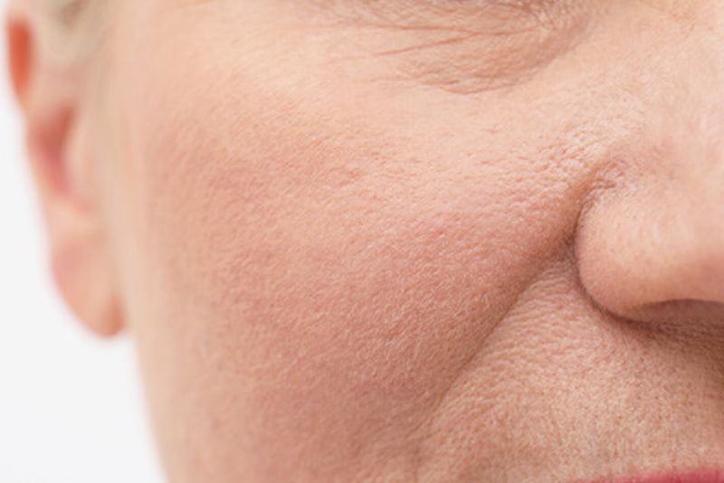 Vùng da tan filler xuất hiện nếp nhăn