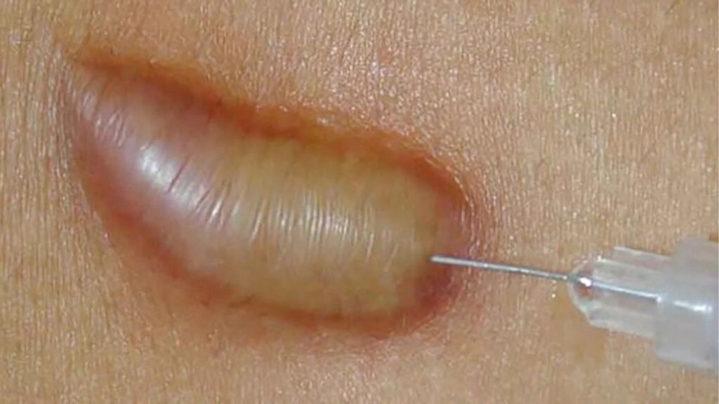 Tiêm sẹo lồi là gì? Hiệu quả, quy trình và những điều cần biết
