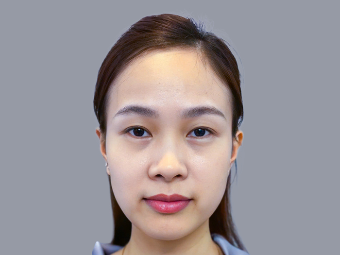 Mí 2 bên không đều