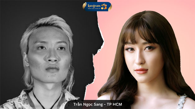 Người mẫu chuyển giới – Trần Ngọc Sang mạnh dạn thay đổi gương mặt sau nhờ chỉnh hình