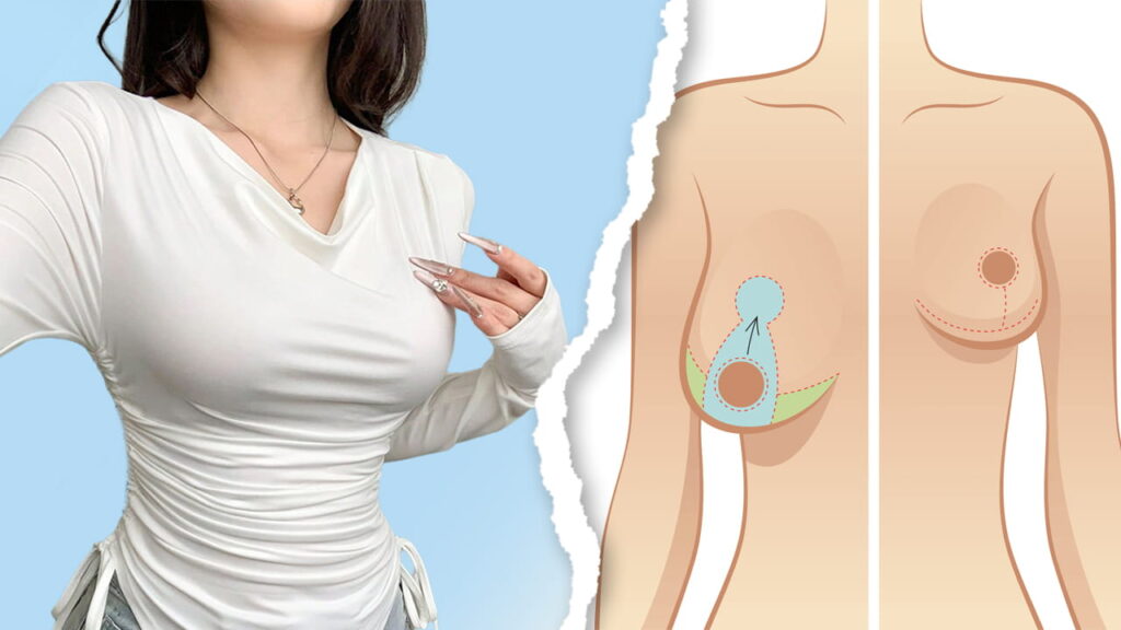 Treo ngực sa trễ không đặt túi: Giải pháp an toàn, tự nhiên cho vòng 1