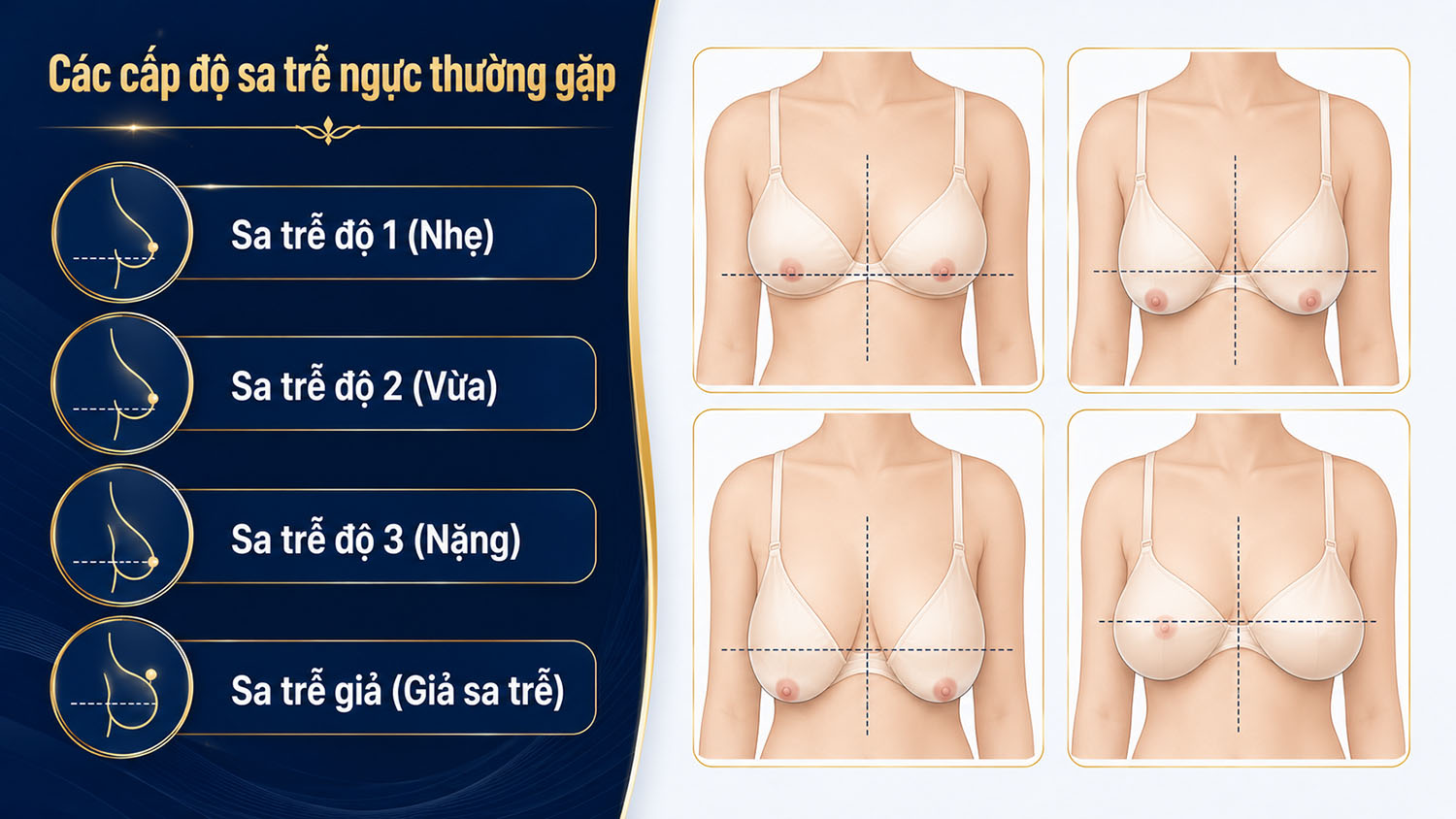 ảnh mô tả Các cấp độ sa trễ ngực thường gặp