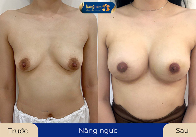 Nâng ngực chảy xệ nếu chăm sóc tốt sẽ duy trì vẻ đẹp lâu dài