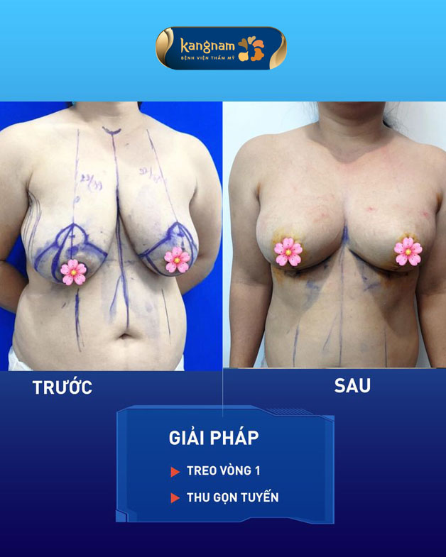 Nâng ngực sa trễ kết hợp thu gọn tuyến, giúp khách hàng sở hữu bầu ngực cân đối