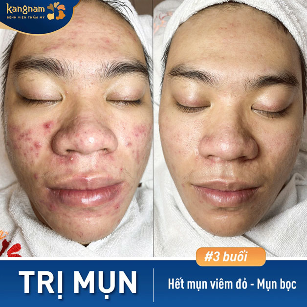 Mụn viêm to ở thái dương, mũi, má, trán được giải quyết triệt để