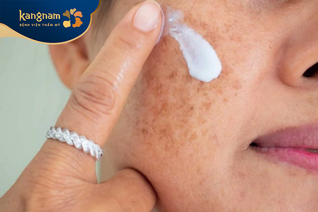 Sử dụng kem bôi, các loại thuốc trị nám mảng