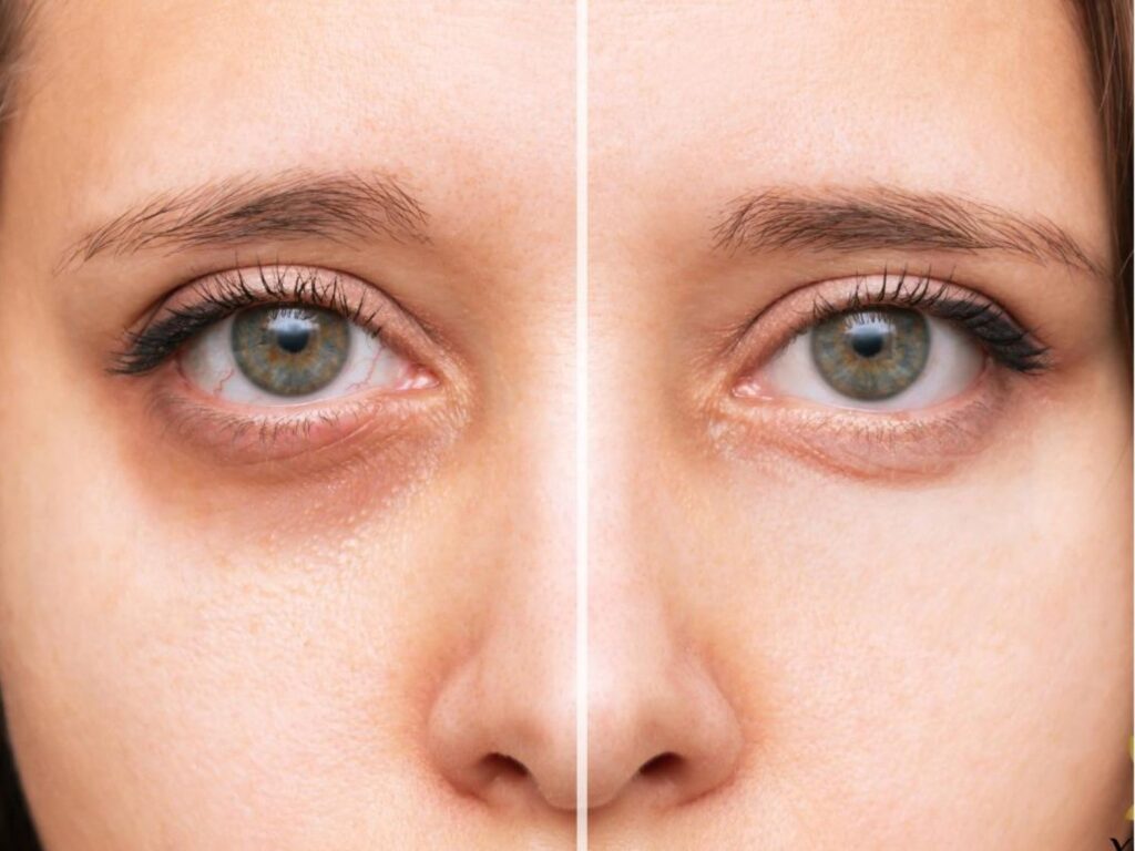 Trị thâm quầng mắt bằng laser