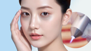 Trị thâm quầng mắt bằng laser có tốt không? Hiệu quả, chi phí & lưu ý