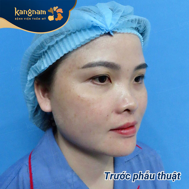 Người có khuyết điểm mũi thấp tẹt, gồ ghề, sóng mũi ngắn, hếch, đầu mũi to, thô