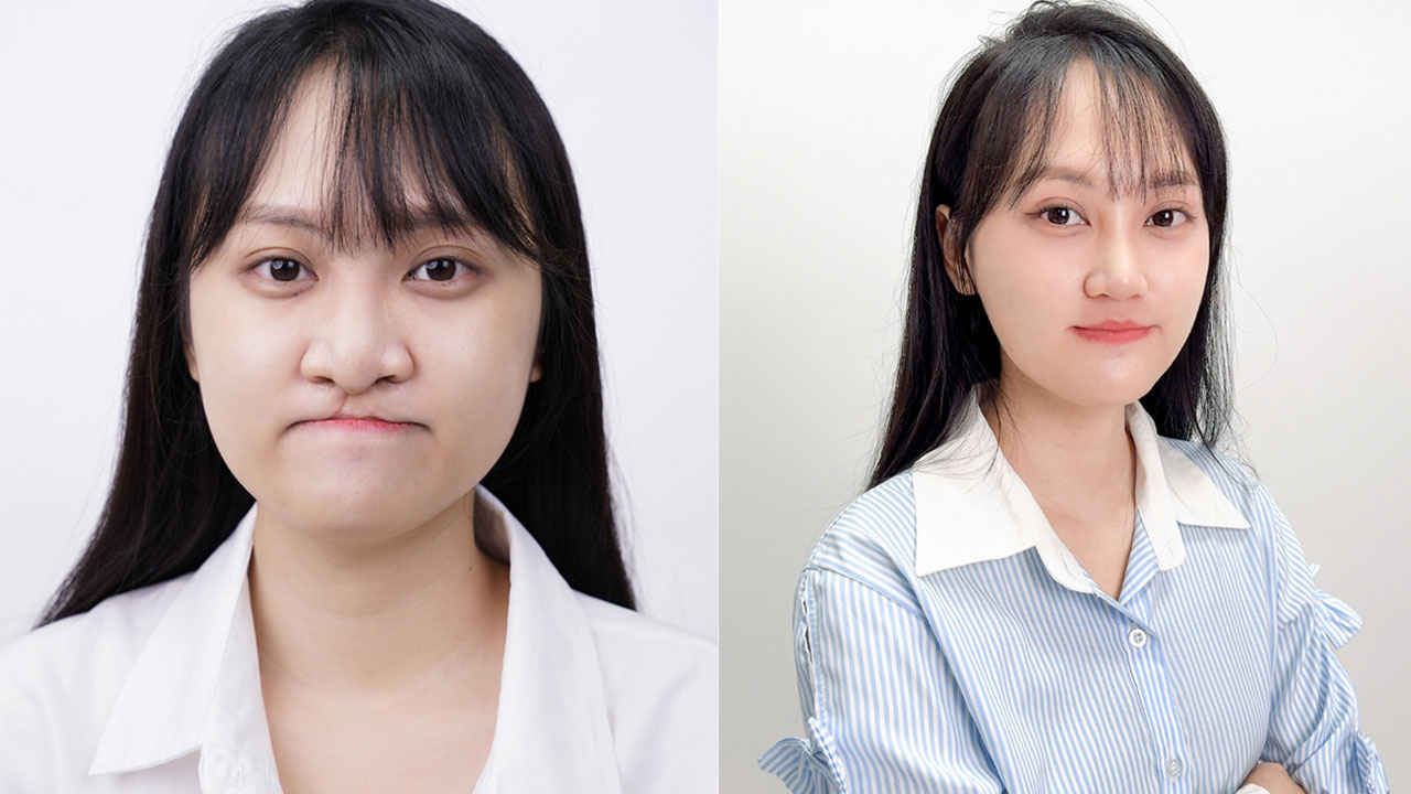 Minh Xuân trước và sau khi chỉnh hàm tại Kangnam
