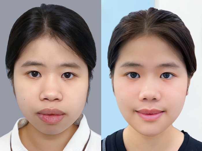 Cằm ngắn vuông chỉ định độn cằm tự thân