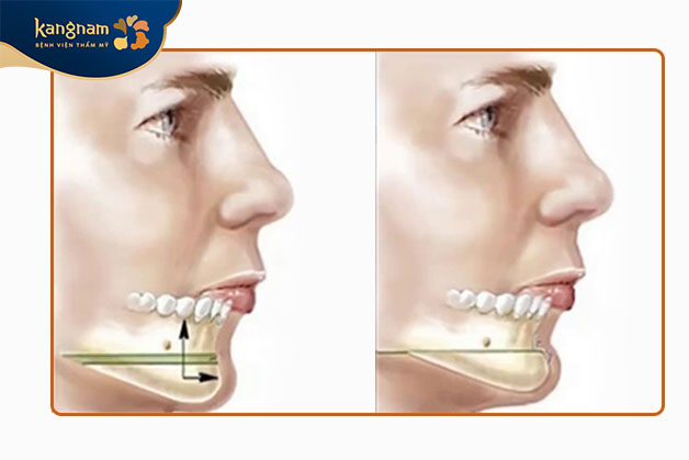 Trượt cằm là phương pháp thẩm mỹ giúp thay đổi hình dạng cằm