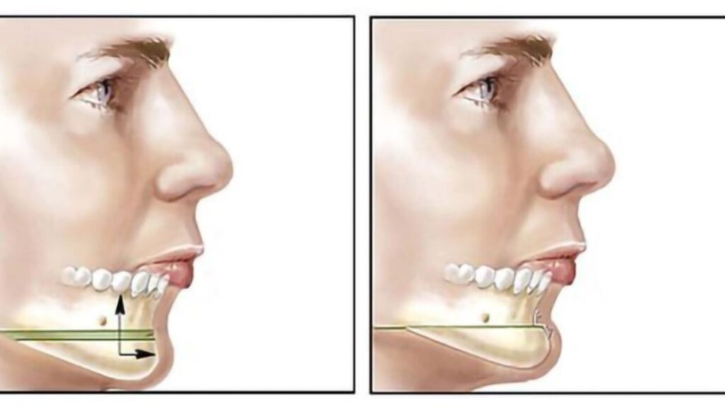 Trượt cằm là gì? Ưu điểm xương tự thân & Lộ trình hồi phục