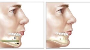 Trượt cằm là gì? Ưu điểm xương tự thân & Lộ trình hồi phục