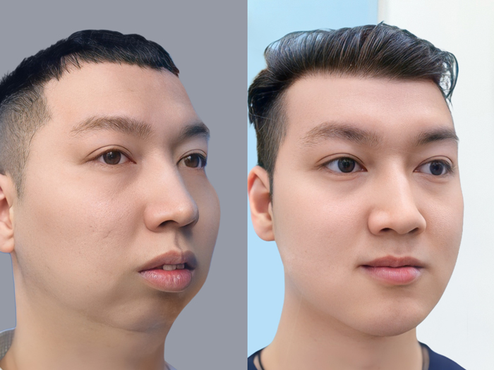 Người có cằm ngắn, lẹm